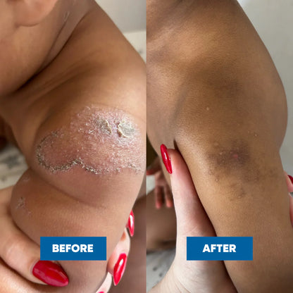 MooGoo Eczema & Psoriasis cream ..Gotu Kola 120gm